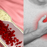 Apolipoproteina A e infarto