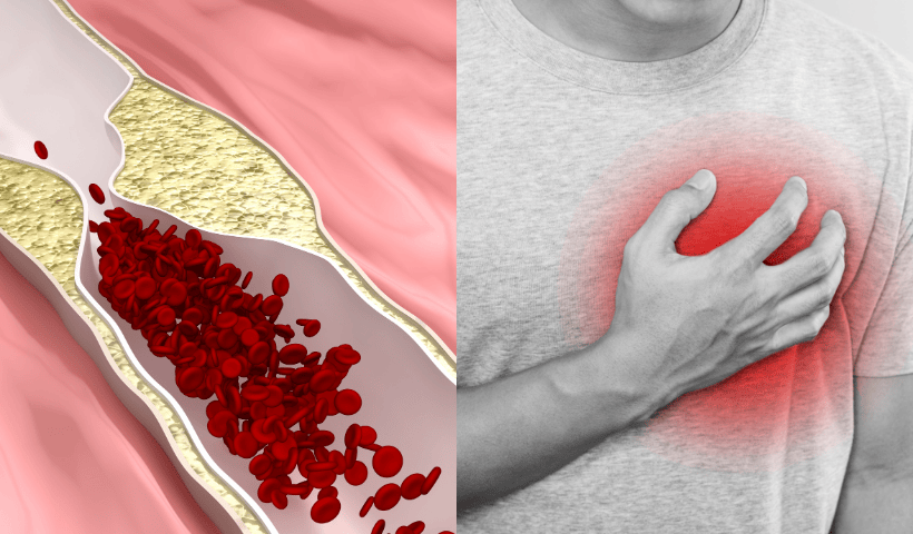 Apolipoproteina A e infarto